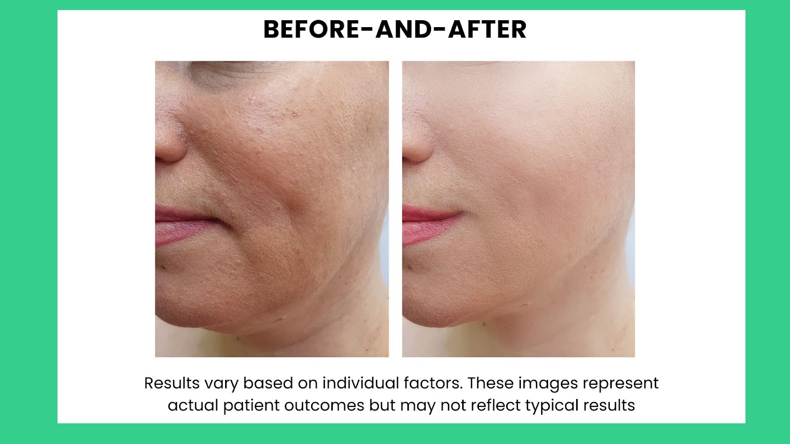 Before-and-after photo of facial treatment with disclaimer noting results vary and may not reflect typical patient outcomes - Wolf IQ