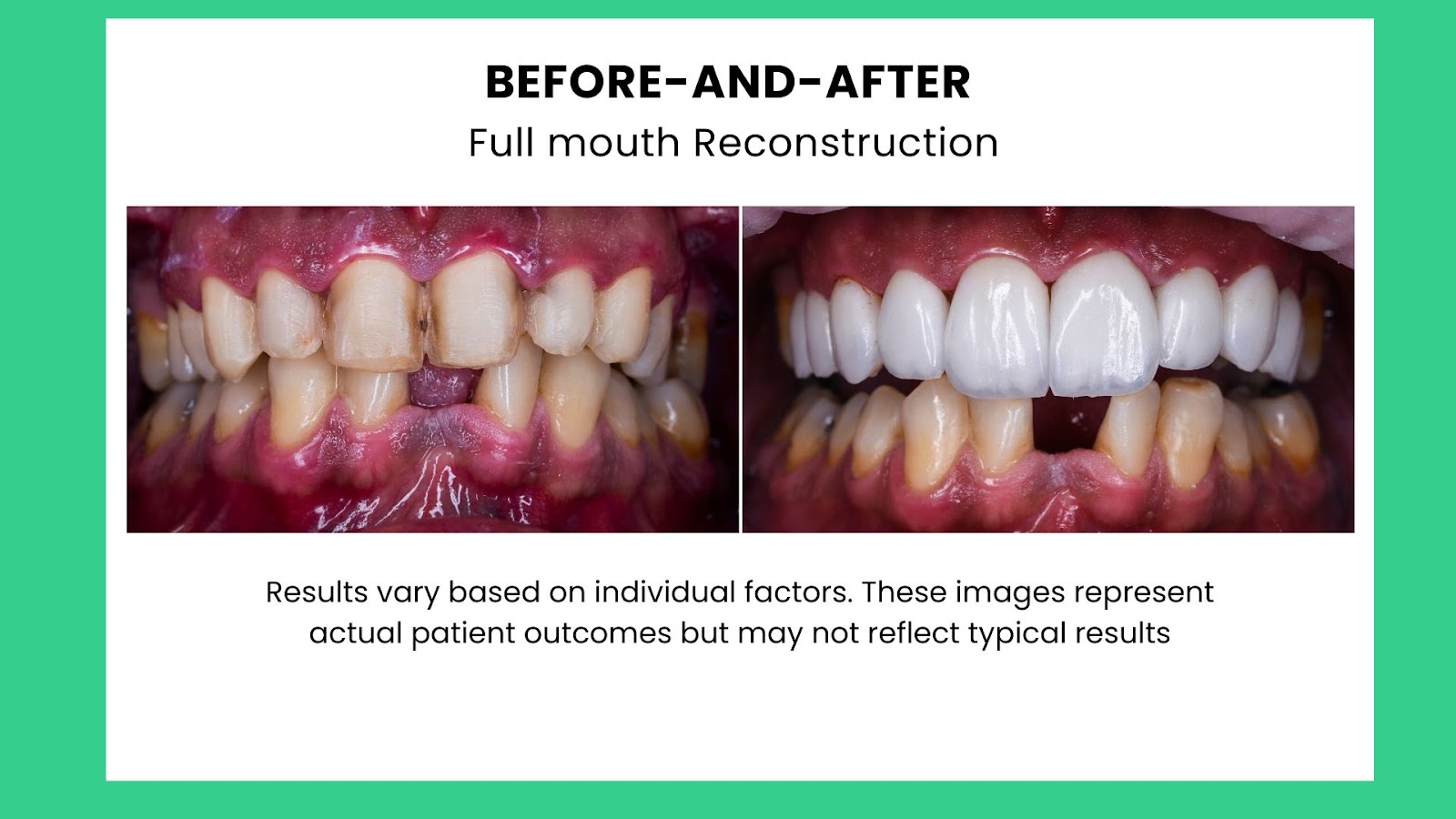 Before-and-after full mouth reconstruction images used in medical marketing to highlight dental treatment results and engage patients on social media platforms - Wolf IQ